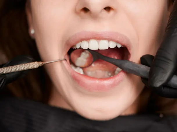 Cavities / Fillings