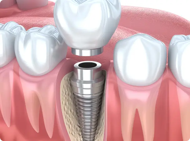 Dental Implants