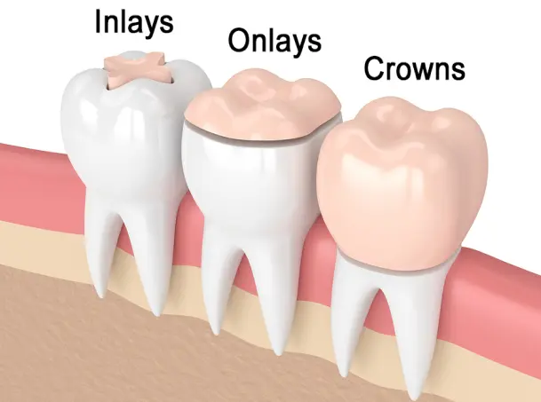 Inlays / Onlays