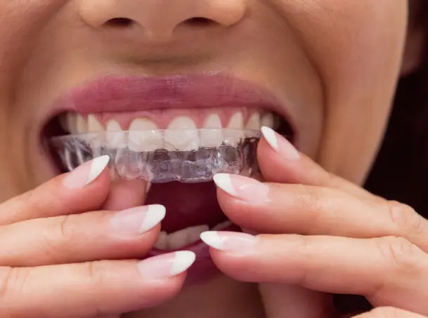 Invisalign